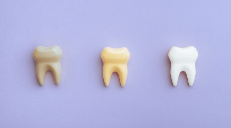 5 mitos e verdades sobre manchas nos dentes