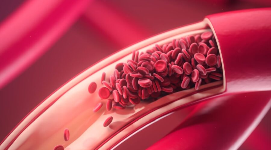 Como o calor e as viagens podem aumentar o risco de trombose no fim de ano