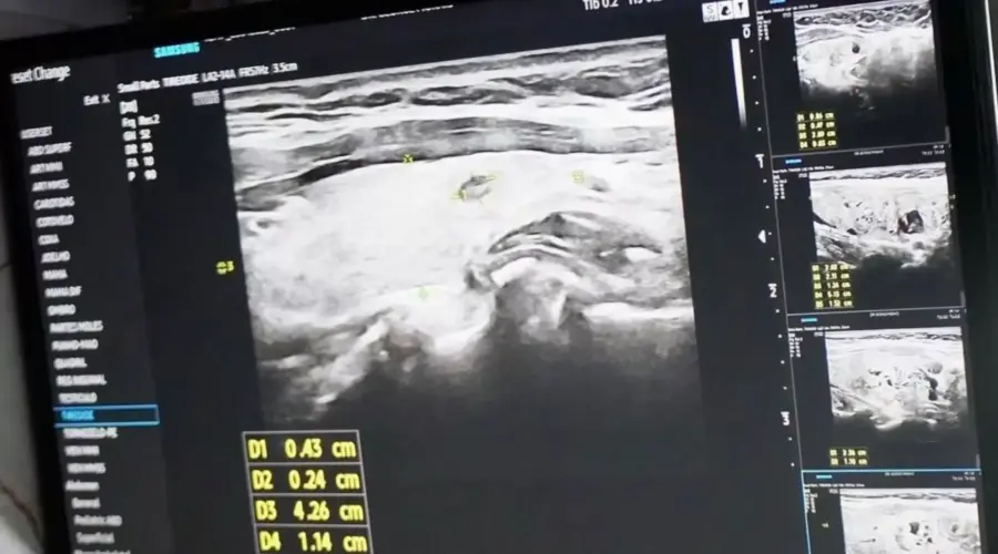 Mutirão atende 300 em prevenção ao câncer em Goianésia